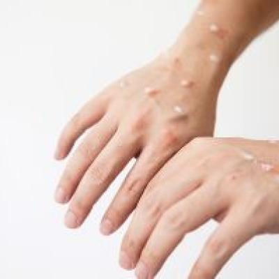 Warga Kepulauan Meranti Dinyatakan Negatif Virus Cacar Monyet Berdasarkan Hasil Uji Labor