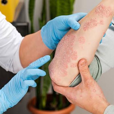 Bintan Raih Status Bebas Penyakit Frambusia dari Kemenkes RI